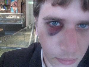 Stoller's Black Eye